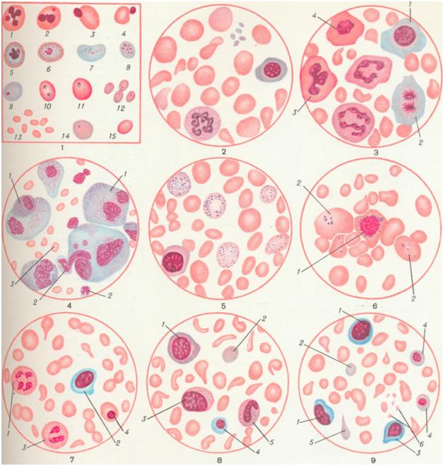 Пойкилоцитоз анемия. Нормобласты в мазке крови. Апластическая анемия эритроциты форма. Анизоцитоз пойкилоцитоз гипохромия, тельца Джоли. Патологические клетки крови.